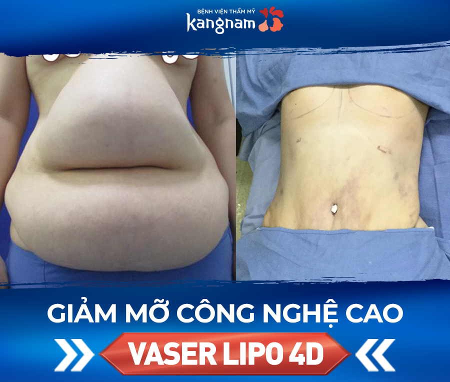 có nên đi hút mỡ bụng không