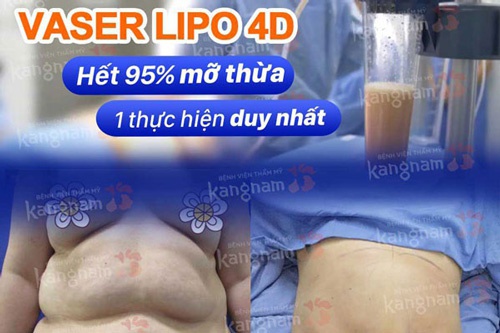 hút mỡ bụng ở đâu tốt