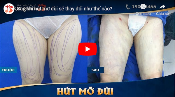 video hút mỡ đùi