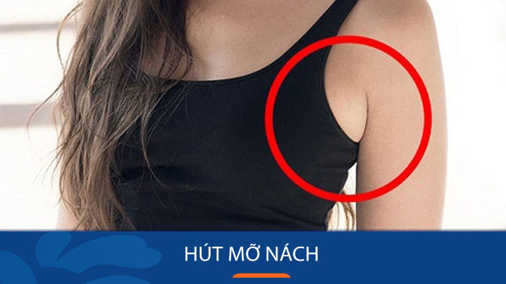 Hút Mỡ Nách: Giải Pháp An Toàn và Hiệu Quả Loại Bỏ Mỡ Thừa Vùng Nách