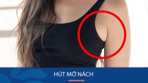 Hút Mỡ Nách: Giải Pháp An Toàn và Hiệu Quả Loại Bỏ Mỡ Thừa Vùng Nách