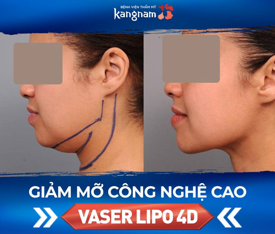 Không còn mỡ nọng cằm, cằm thanh thoát hơn.