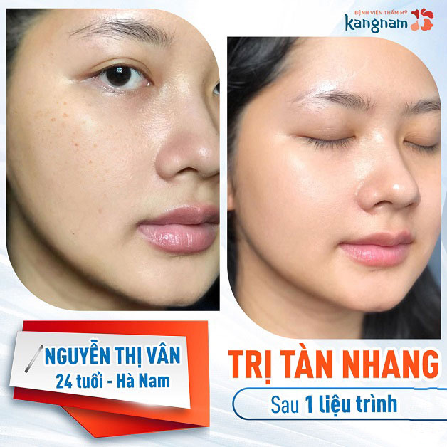 Khách hàng Nguyễn Thị Vân 24 Tuổi trị khỏi tàn nhang sau 1 liệu trình