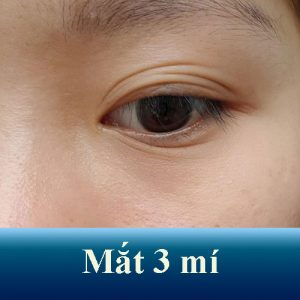 Mắt 3 mí – Nguyên nhân và cách khắc phục cho đôi mắt rõ nét