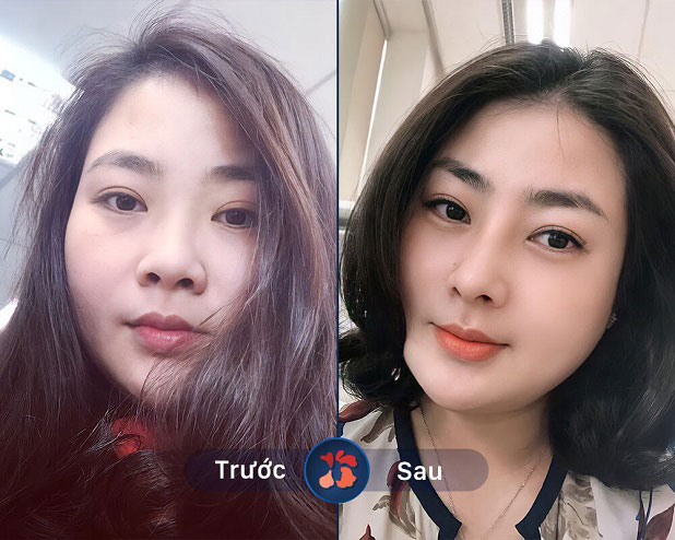 Sống mũi nâng cao thẳng, đầu mũi đẹp tự nhiên không bị bóng đỏ sau khi thẩm mỹ mũi 