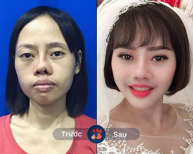 Mũi biến dạng, mất cấu trúc mũi do tai nạn và 2 lần phẫu thuật thẩm mỹ mũi bị hỏng đã được "giải cứu thành công" tại Kangnam