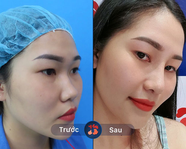 Kết quả trước và sau khi khách hàng nâng mũi tại Kangnam