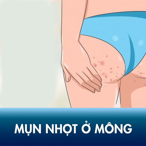 Mụn nhọt ở Mông là bệnh gì? Có nguy hiểm không? Cách trị nhanh nhất