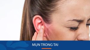 Mọc mụn trong tai là bệnh gì? Có nguy hiểm không?