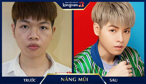 nâng mũi cho ca sĩ Đức Phức bằng sụn vành tai