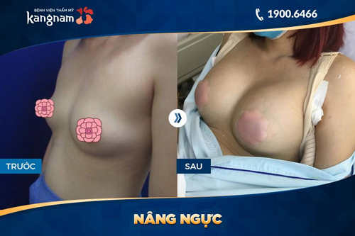 ngực bên to bên nhỏ khi cho con bú 