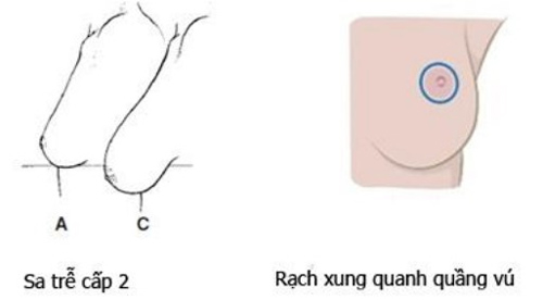 nâng ngực sa trễ 