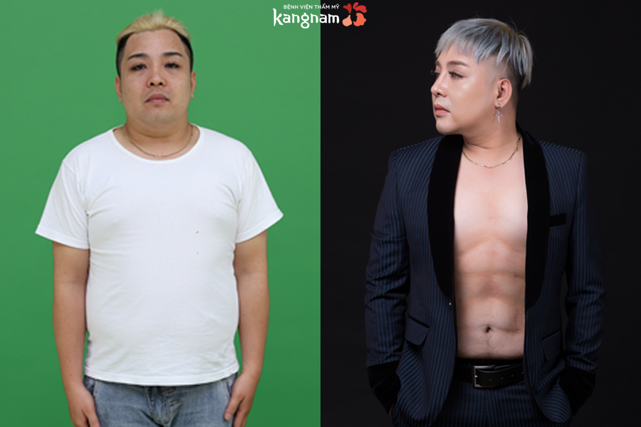kết quả Nhật ký hút mỡ 