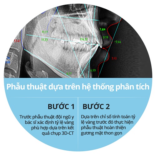 Phẫu thuật gọt xương hàm giá bao nhiêu