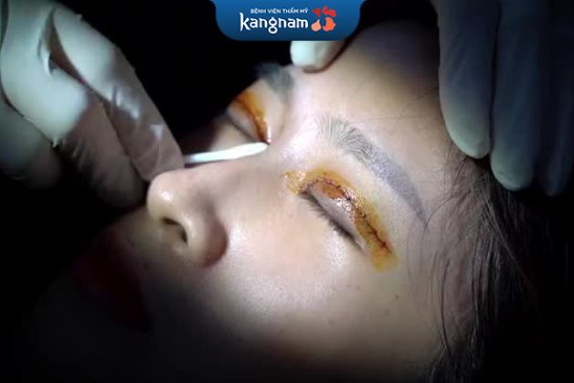 Quy trình chỉnh sửa mí mắt bị cắt hỏng tại Kangnam.