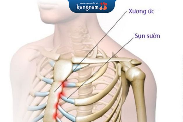 Sụn sườn nâng mũi thường được lấy tại vị trí thứ 6-7-8 bên ngực phải