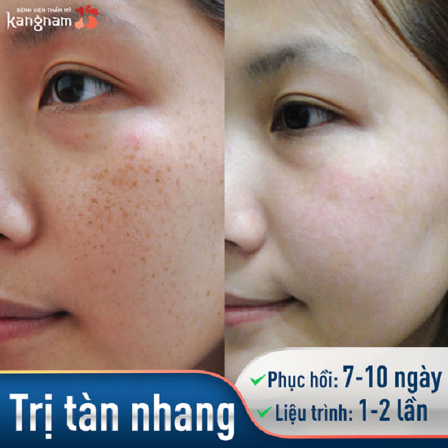 Điều trị nám, tàn nhang bằng Laser Toning giúp bạn sớm lấy lại làn da sáng mịn, đều màu