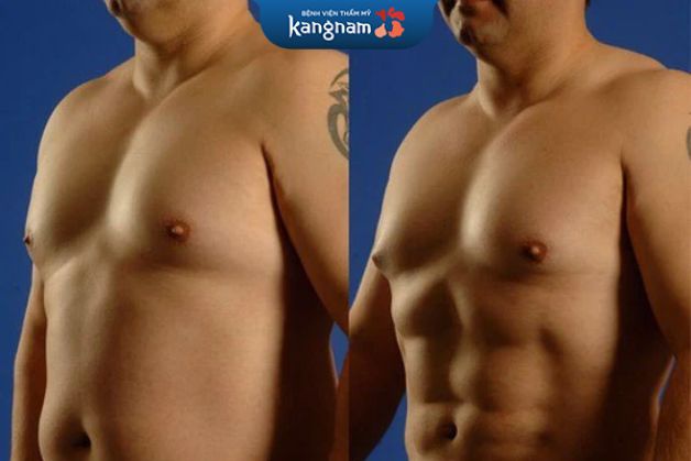Khách hàng nam tính sau tạo hình body 6 múi tại Bệnh Viện Kangnam