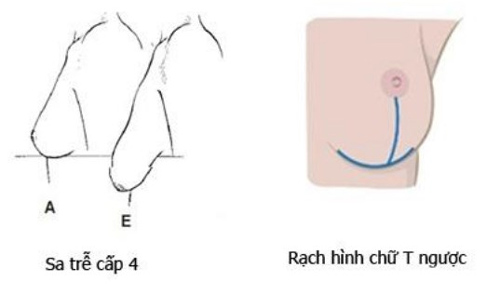 ngực sa trễ