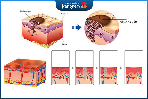 Cơ chế tác động sâu tận hạ bì da, "hút" toàn bộ hắc tố melanin gây tàn nhang
