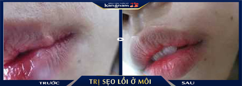 Vết sẹo trong viền môi được khắc phục hoàn toàn chỉ sau 1 liệu trình điều trị tại BV Kangnam