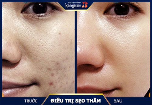 Làn da trở nên căng mịn, sáng hồng sau khi điều trị sẹo thâm bằng phương pháp cấy tinh chất