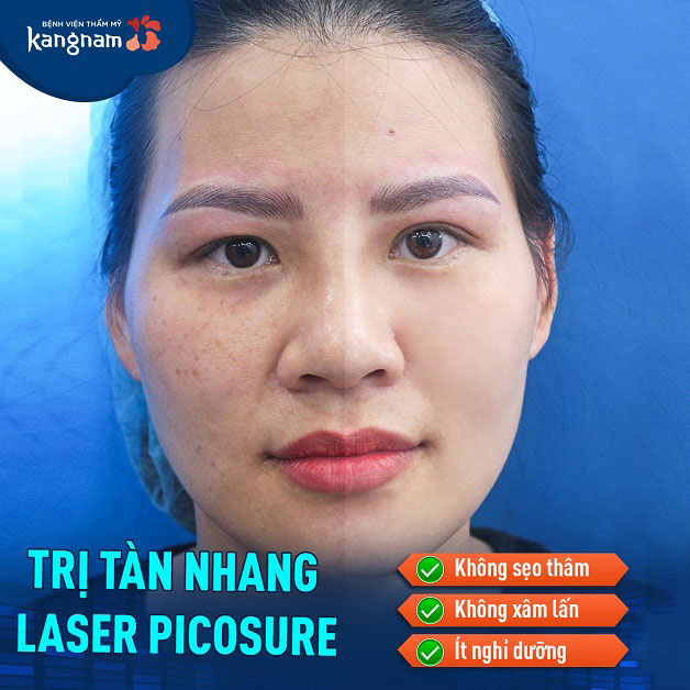 Kết quả sau khi trị tàn nhang bằng Laser Picosure không để lại sẹo thâm