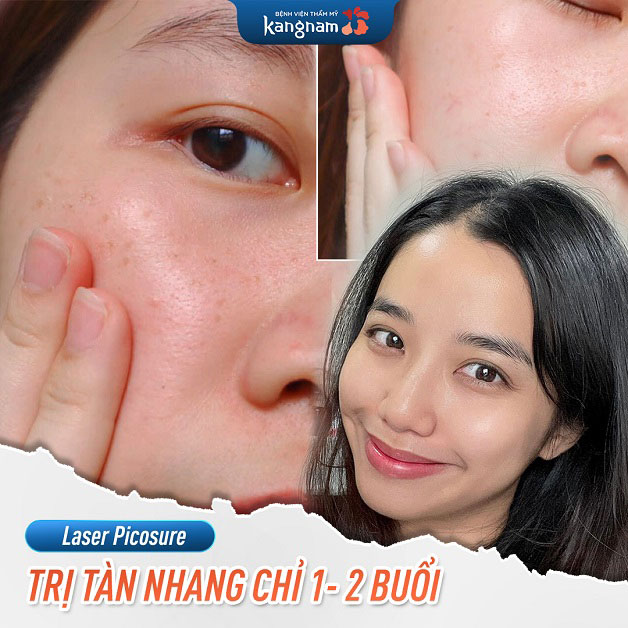 Trị tàn nhang Laser Picosure sau 1-2 buổi tại Kangnam