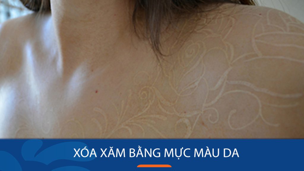 Xóa xăm bằng mực màu da – BVTM Kangnam cảnh báo