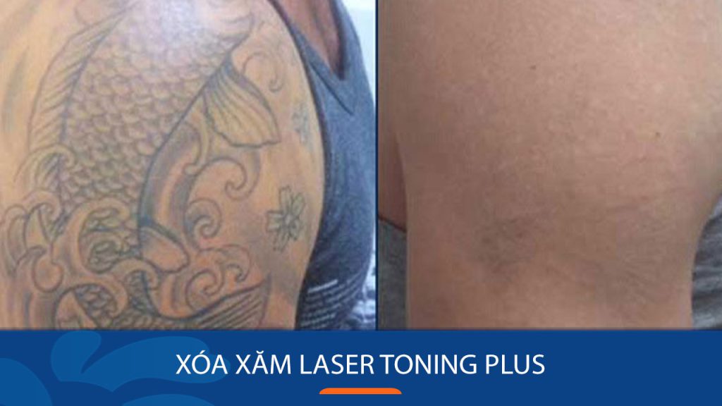 Xóa xăm Laser Toning Plus – Thách thức mọi hình xăm khó