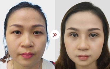 hình ảnh cắt mí