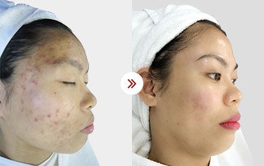 điều trị da