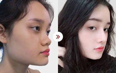 hình ảnh gọt hàm