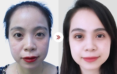 kết quả cắt mí