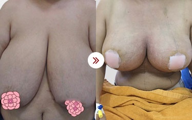 hình ảnh nâng ngực