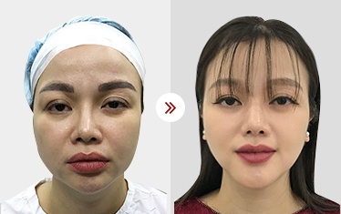 gọt mặt v line