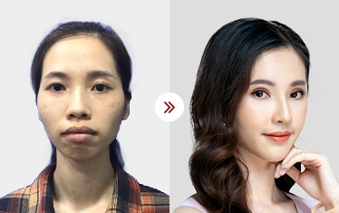 sửa gò má