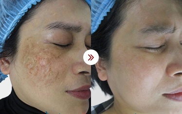 điều trị nám