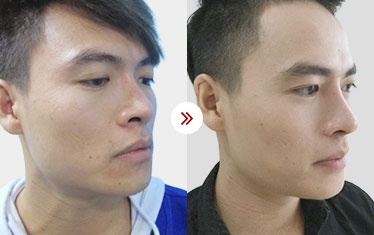 hình ảnh sửa mũi