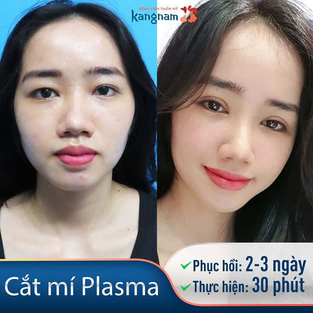 Khách hàng sau khi cắt mí Plasma