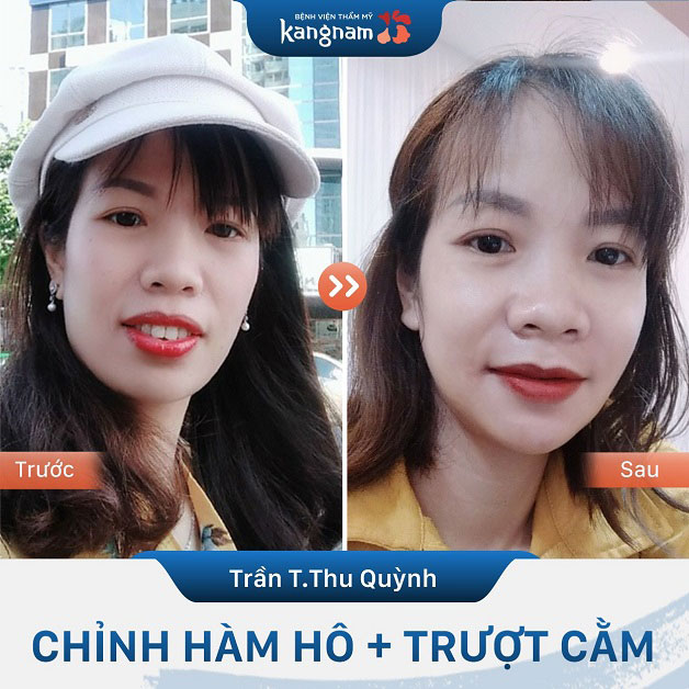 Chị Quỳnh trở nên đẹp tự nhiên sau khi chỉnh hàm hô và trượt cằm