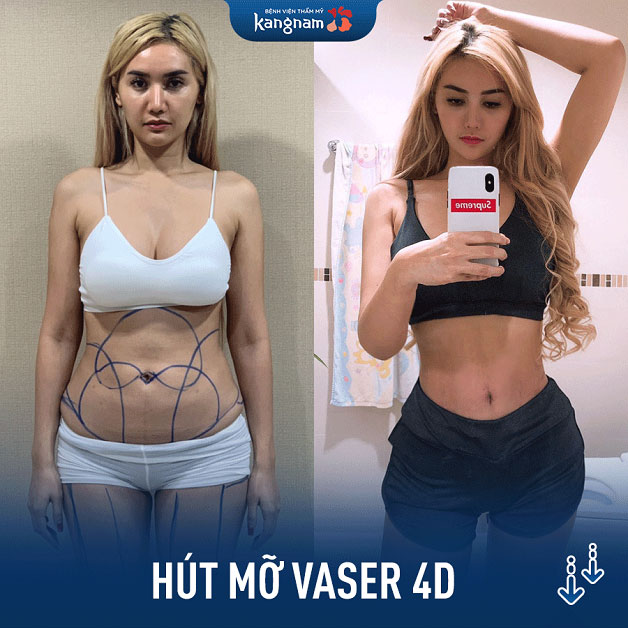 Kết quả trước và sau khi khách hàng hút mỡ Vaser 4D