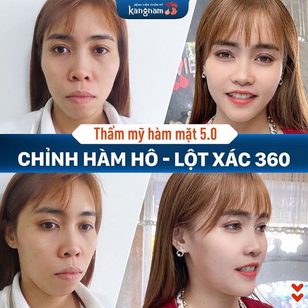Khách hàng chỉnh hàm hô gương mặt dịu dàng và nữ tính hơn