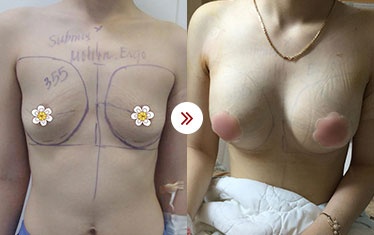 kết quả nâng ngực