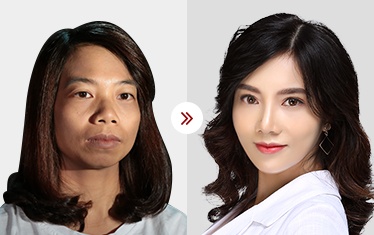 gọt mặt v line 3d