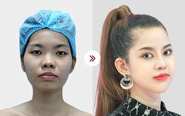 căn chỉnh gò má