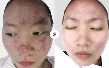 điều trị mụn