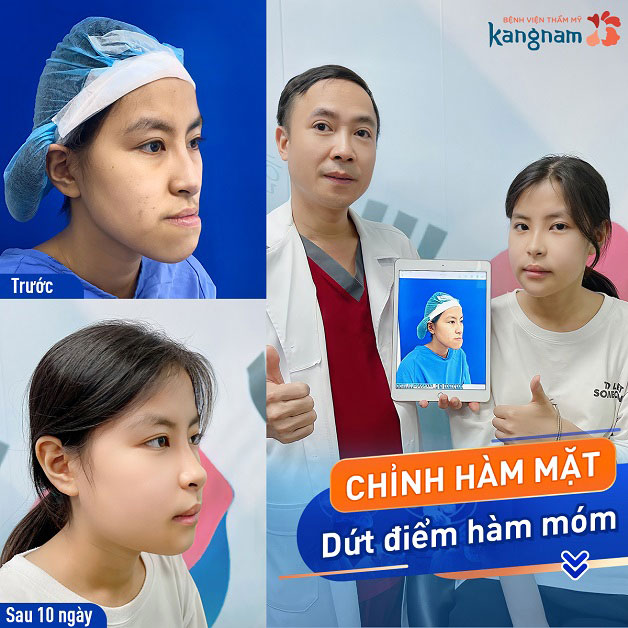 Khách hàng chỉnh hàm hô gương mặt dịu dàng và nữ tính hơn