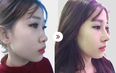 kết quả sửa mũi