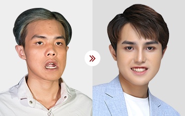 chỉnh hàm hô móm
